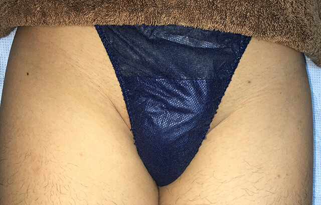 施術部位/Vゾーン脱毛アフター